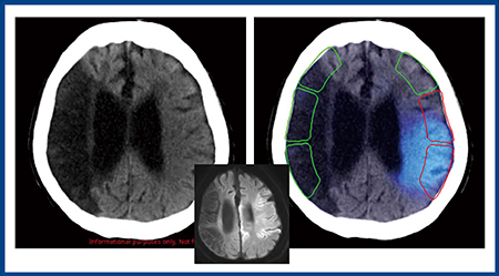 図4　Ischemia analysisのCT-ASPECTS自動計算2