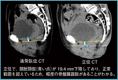 図4　骨盤臓器脱（70歳代，女性）の早期診断