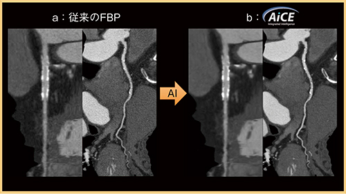 図4　Deep Learning Reconstruction（AiCE）による画質改善