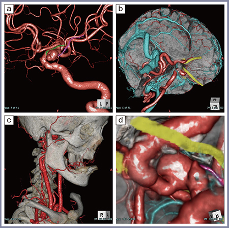 図3　症例3：内頸動脈瘤
