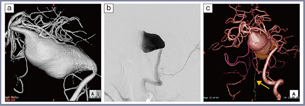 図4　症例4：脳底動脈巨大紡錘状動脈瘤
