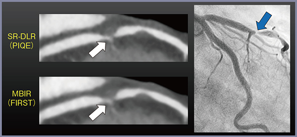 図5　320列ADCTによるFIRST，PIQE，冠動脈造影の比較