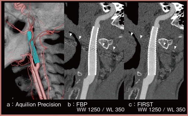 図1　Aquilion Precisionによる頸動脈ステント術後評価 （参考文献1）より引用転載）
