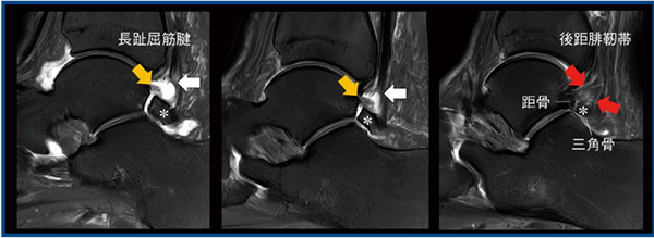 図4　PIQEによる長趾屈筋腱の断裂および三角骨への後距腓靭帯の付着部の描出