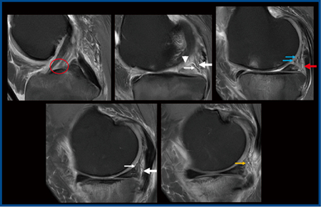 図5　PIQEによる交通外傷症例の膝関節損傷および靭帯断裂の描出