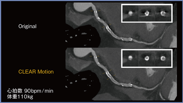 図6　CLEAR Motionによる高心拍・高体重患者のステントの描出の改善（短軸像）