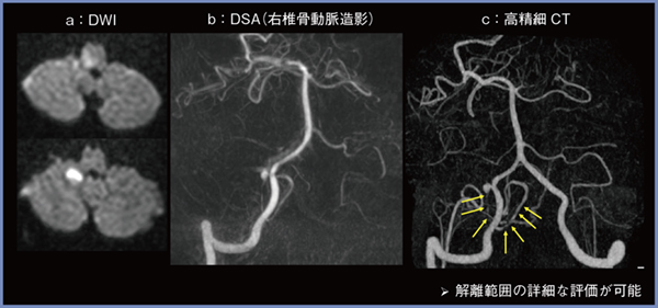 図2　右後下小脳動脈単独解離