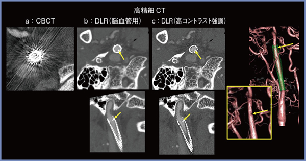 図5　内頸動脈ステント内狭窄