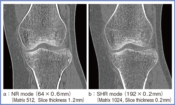 図1　膝関節におけるPCD-CTのNRモードとSHRモードの空間分解能の比較