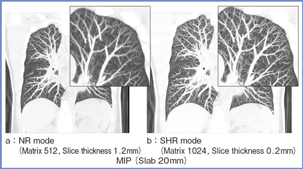図2　肺におけるPCD-CTのNRモードとSHRモードの空間分解能の比較