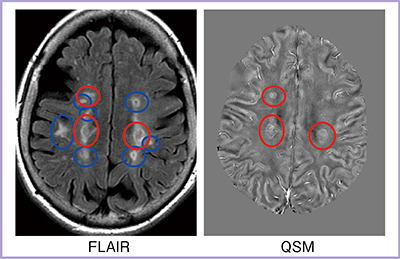 図1　多発性硬化症のFLAIRとQSM