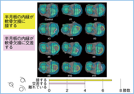 図3　半月板の内縁と軟骨欠損の関係 （参考文献4）より引用改変）