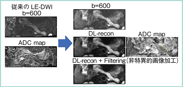 図1　DL-reconを用いたLE-DWIによる膵の描出の改善