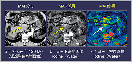 図3　症例3：肝細胞がん，左下横隔静脈コイル留置後