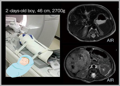 図1　AIR AAの柔軟性を生かした乳児の撮像