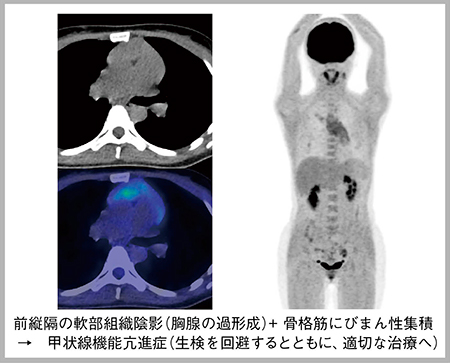 図1　症例1（30歳代，女性）：甲状腺機能亢進症