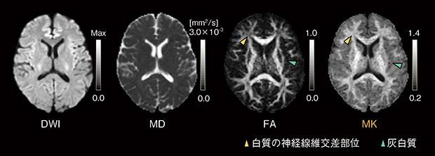 図3　Diffusion Tensor Imaging（DTI）の指標Fractional Anisotropy（FA）とDiffusion Kurtosis Imaging（DKI）の指標Mean Kurtosis（MK）の比較