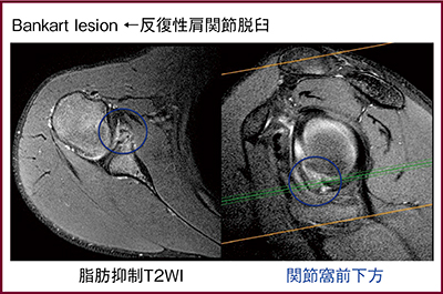 図4　Bankart損傷の描出