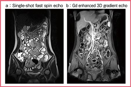 図1　FOV 50cmを生かした腸管全体の評価