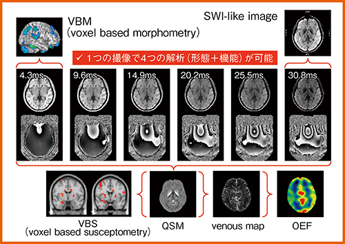 図2　QSMとVBMのハイブリッド撮像法（W.I.P.）