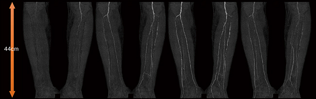 両下肢重症下肢虚血（CLI）に対する血管内治療（EVT）の1か月後フォローアップ検査画像。両下肢ともに治療後閉塞なく血流が保たれていることが確認できる。CLI患者のように左右の下肢で血流速度が違う場合，通常のCTAでは撮影タイミングの違いで血管抽出不良が生じる可能性があるため，4D撮影によって血流状態を把握することが重要となる（撮影範囲44cm，管電圧70kVp）。