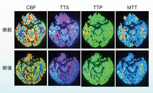 図1　症例1のCTP画像（Definition AS+） 右側頭葉の血流遅延とその改善が認められる。