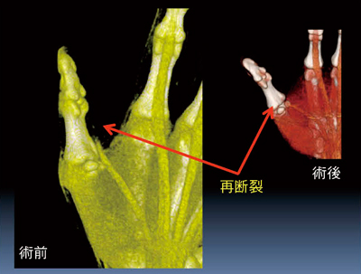図6　症例4：母指IP関節屈曲不能