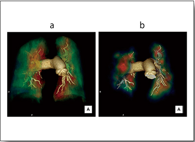 図3　症例2：CTEPH（40歳代，女性）におけるCTAとのフュージョン画像