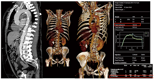 図1　Case1：Low kVイメージングによる造影剤量の低減（Whole-Body CT，70kV，造影剤量20mL）