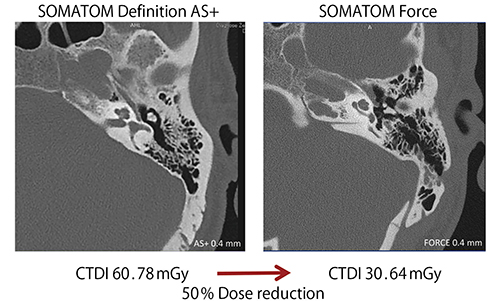 図7　側頭骨のCT画像：SOMATOM Definition AS+（zUHRフィルタあり）とSOMATOM Force（zUHRフィルタなし）の比較