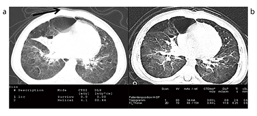 図19　Case12：低線量でのSedation Free CT〔従来CT（a）との比較〕（70kV，DLP 11.8mGy・cm）