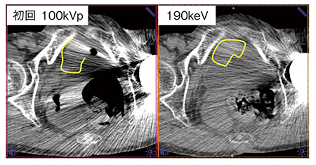図3　症例2：膀胱がん精査（Mono＋の190keV画像）