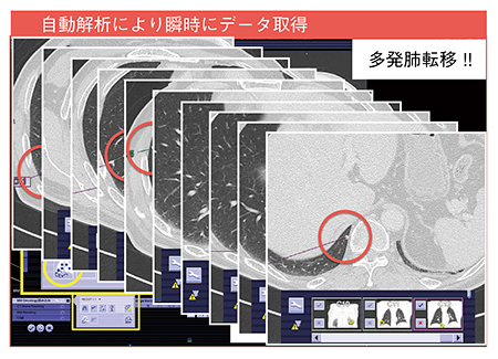 図4　症例3：左腎がんのステージング（Lung CARE）