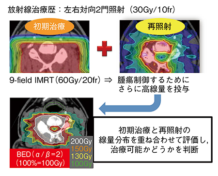 図1　転移性脊椎腫瘍再発例に対する治療戦略