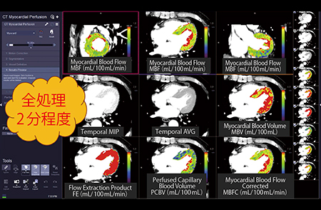 図1　負荷ダイナミック心筋パーフュージョンCTのパラメトリック画像