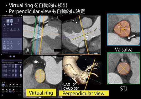 図2　CT TAVI planningによる大動脈弁複合体の計測