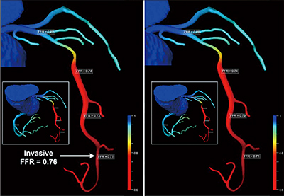 図6　FFR-CT（画像提供：シーメンスヘルスケア株式会社）