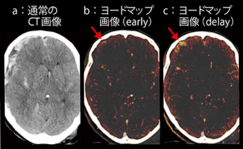 図5　症例5：急性硬膜下出血（71歳，女性）