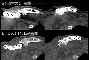 図7　症例7：金属骨折（体内人工物）（43歳，男性）
