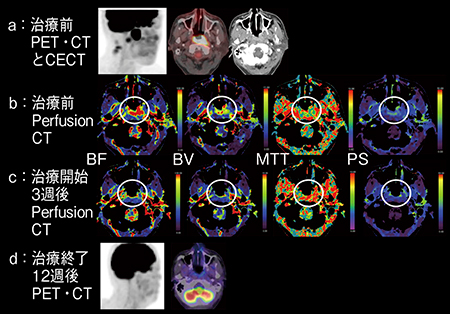 図4　症例3：上咽頭がん（cT4N2M0）