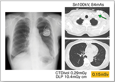 図2　症例2：ペースメーカ留置例