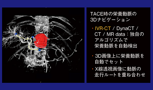 図2　syngo Embolization Guidance