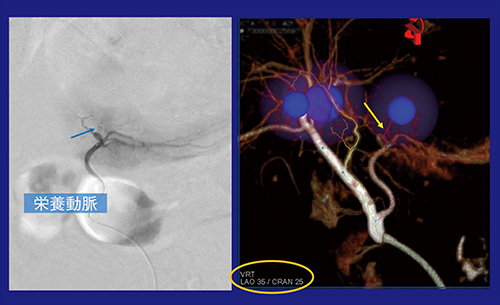 図4　症例1：3D画像の角度に合わせて透視撮影することで栄養動脈を描出