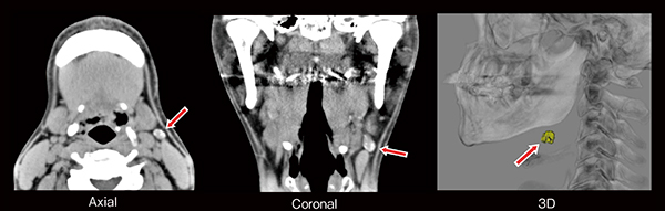 図2　CT lymphographyによるSLNの描出