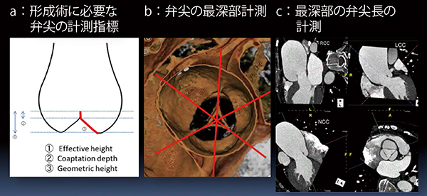 図1　CTによる弁尖長の計測