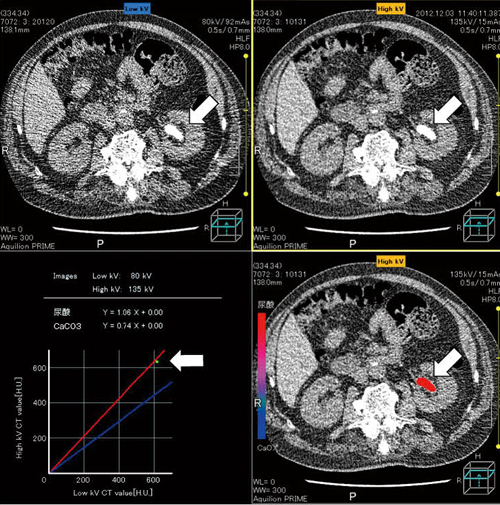 図1　放射線透過性結石例（矢印：35mm大の左腎盂結石）  高電圧（135kV）と低電圧（80kV）のCT値にはほとんど差がなく、尿酸結石と推定された（赤の実線）。