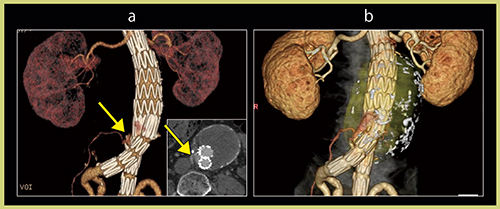 図3　TypeⅡ endoleak症例 a：CTA VR画像　b：DV-CTA画像
