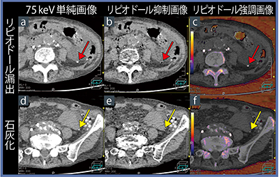 図1　症例1：AAA術後の乳び腹水のリピオドール弁別解析