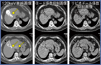 図3　症例3：HCCのTACE後のリピオドールとヨードの弁別解析