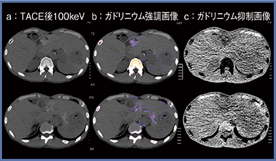 図5　症例4：HCCのガドリニウム造影剤でのTACE後の弁別解析